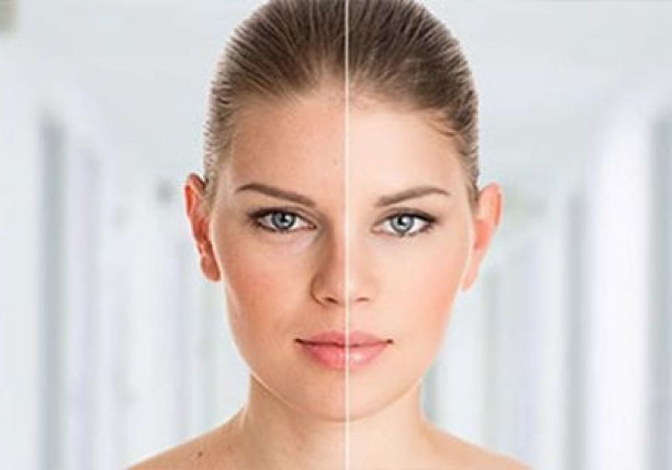 Βotoxlike – Σαν Βοtox Βotoxlike – Σαν Βοtox